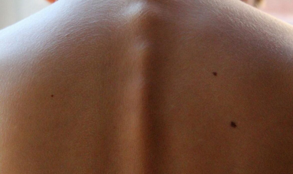 Rimozione nei: cosa c’è da sapere?