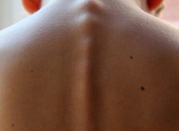 Rimozione nei: cosa c’è da sapere?