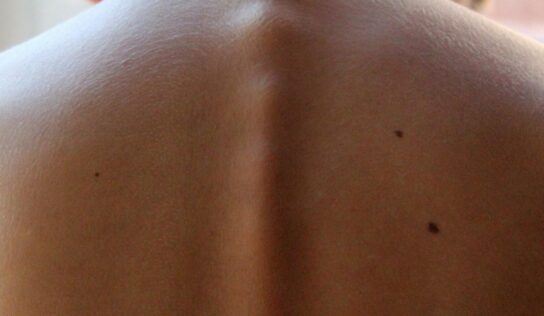 Rimozione nei: cosa c’è da sapere?