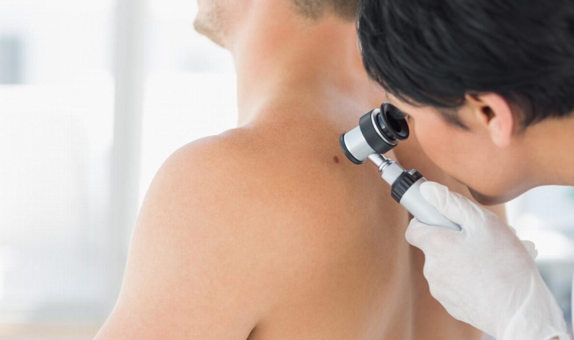 Come guarire da un melanoma