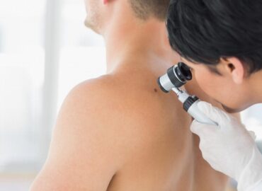 Come guarire da un melanoma