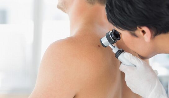 Come guarire da un melanoma